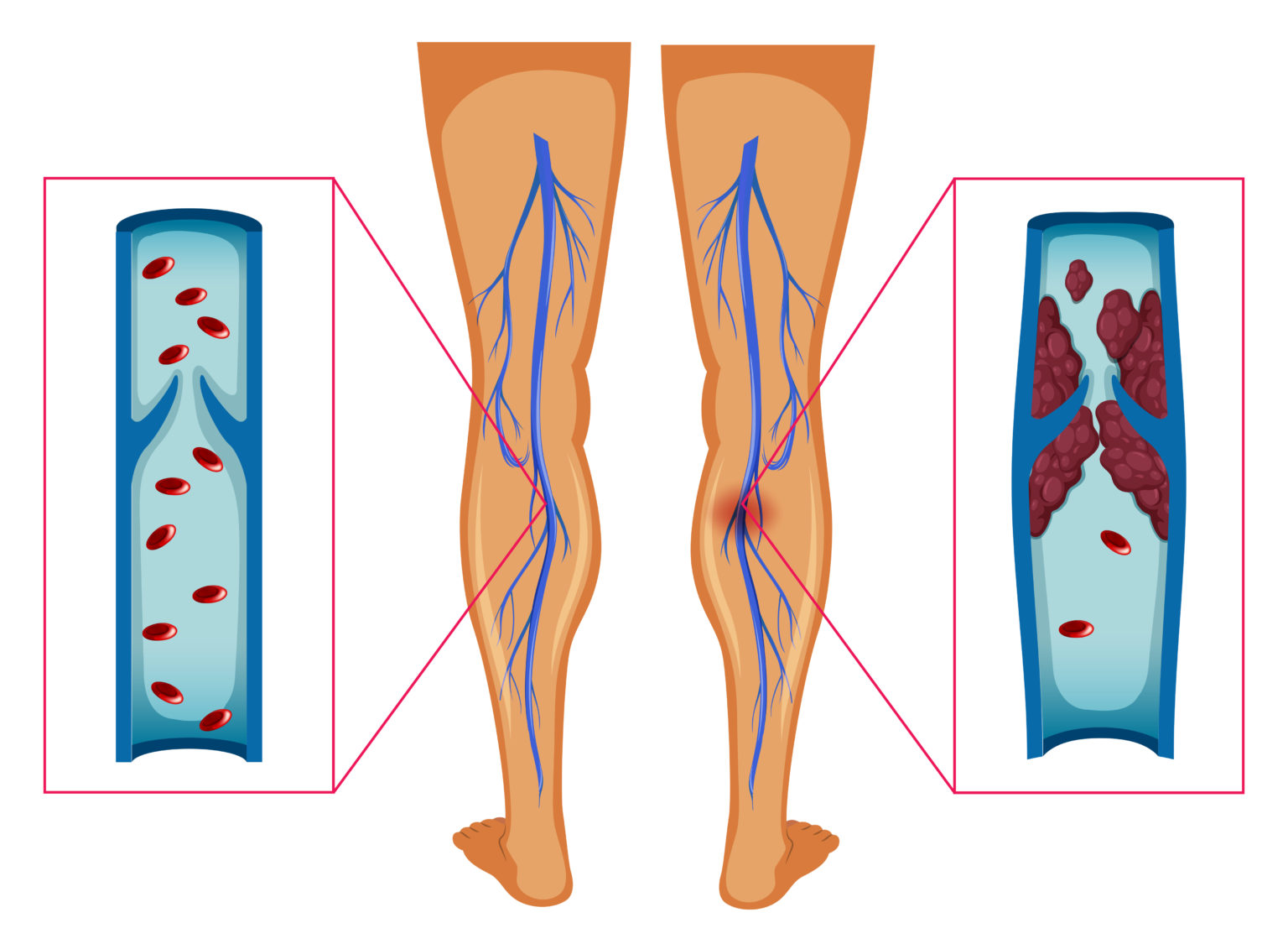 Lowering the Risk of Dangerous Blood Clots Health Concepts